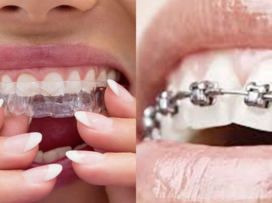 Sonrisas perfectas: Alineadores dentales y brackets de autoligado
