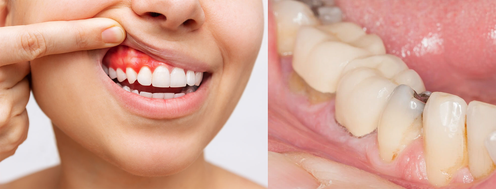 ¿Qué es la fluorosis y como tratarla?