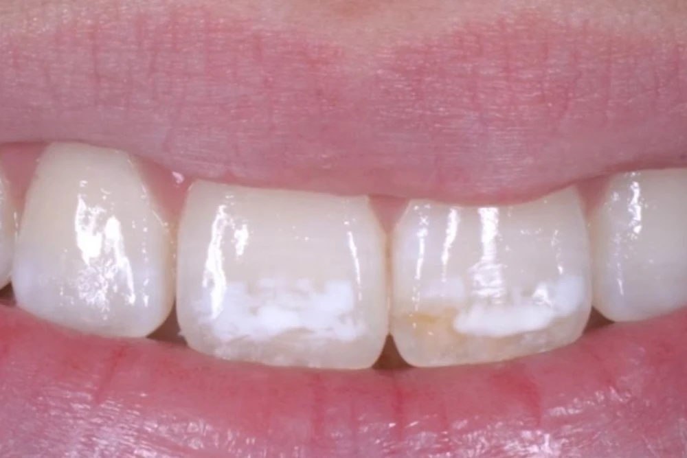 ¿Qué es la fluorosis y como tratarla?