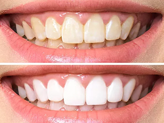 a-que-se-debe-el-color-de-los-dientes