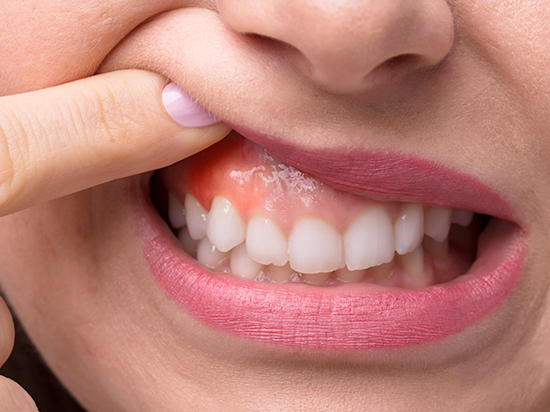 Enfermedades de las encías: lo que debes saber sobre gingivitis y periodontitis