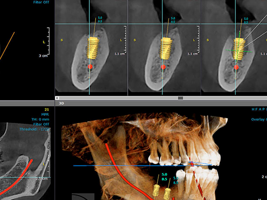 ¿Por qué se coloca un implante dental?