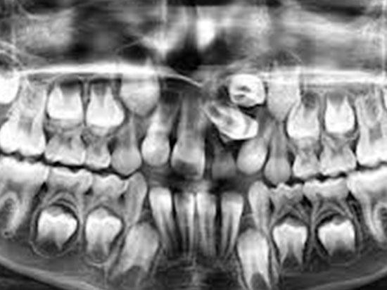 ¿Qué son los dientes supernumerarios o hiperdoncia?