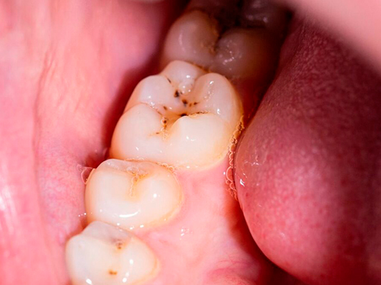 Tipos de caries dentales