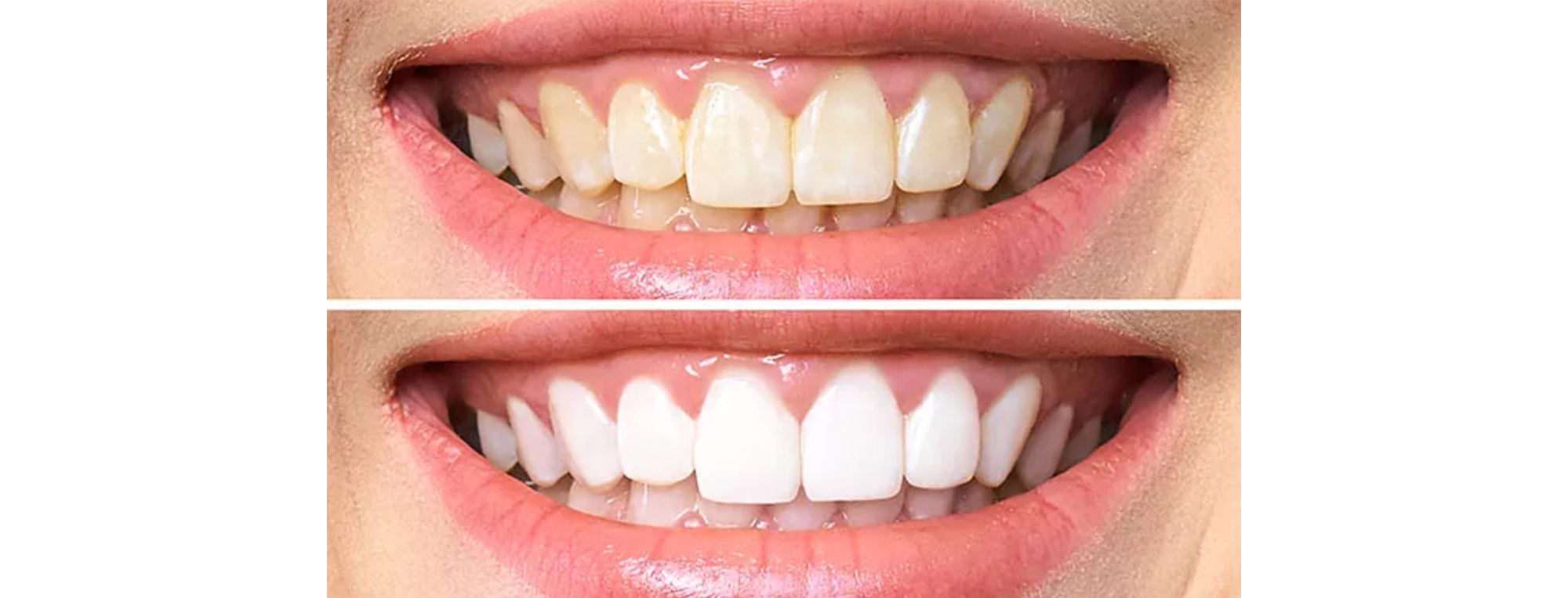 ¿A qué se debe el color de los dientes?