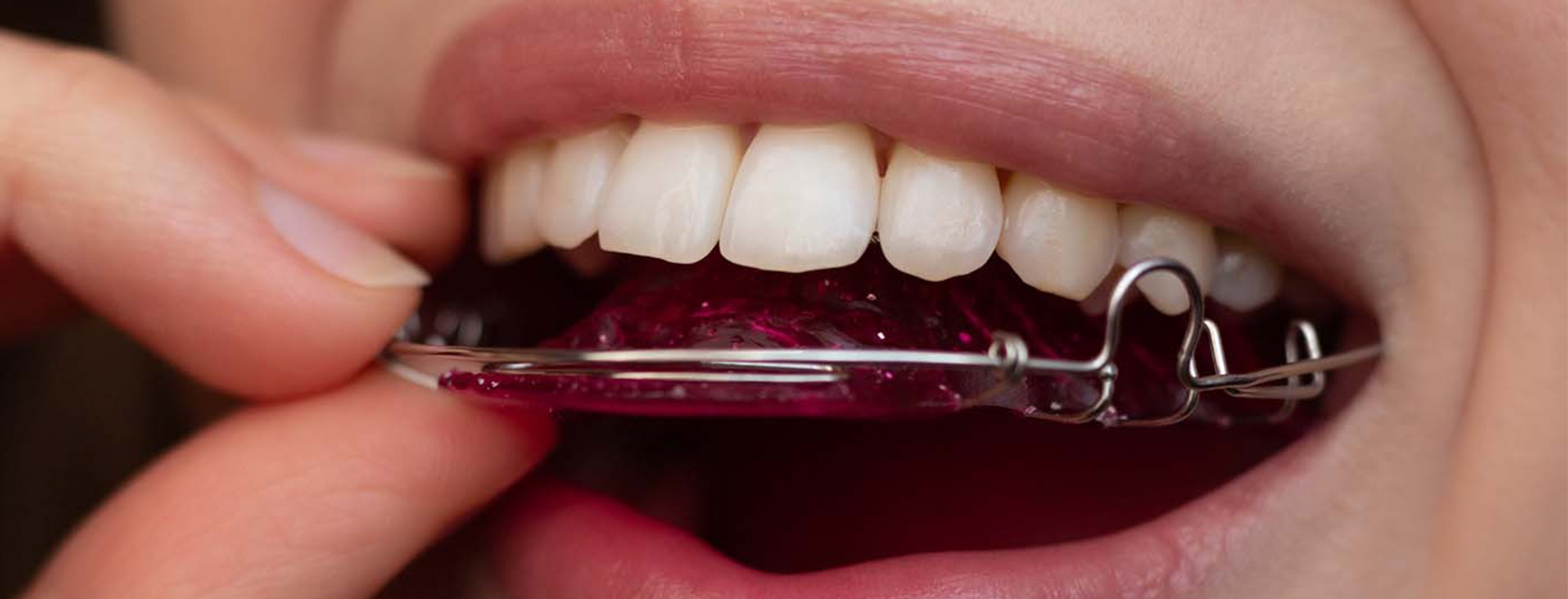 ¿Cuál es la función de los retenedores después de la ortodoncia?