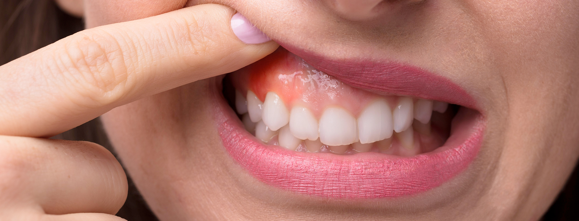 Enfermedades de las encías: lo que debes saber sobre gingivitis y periodontitis