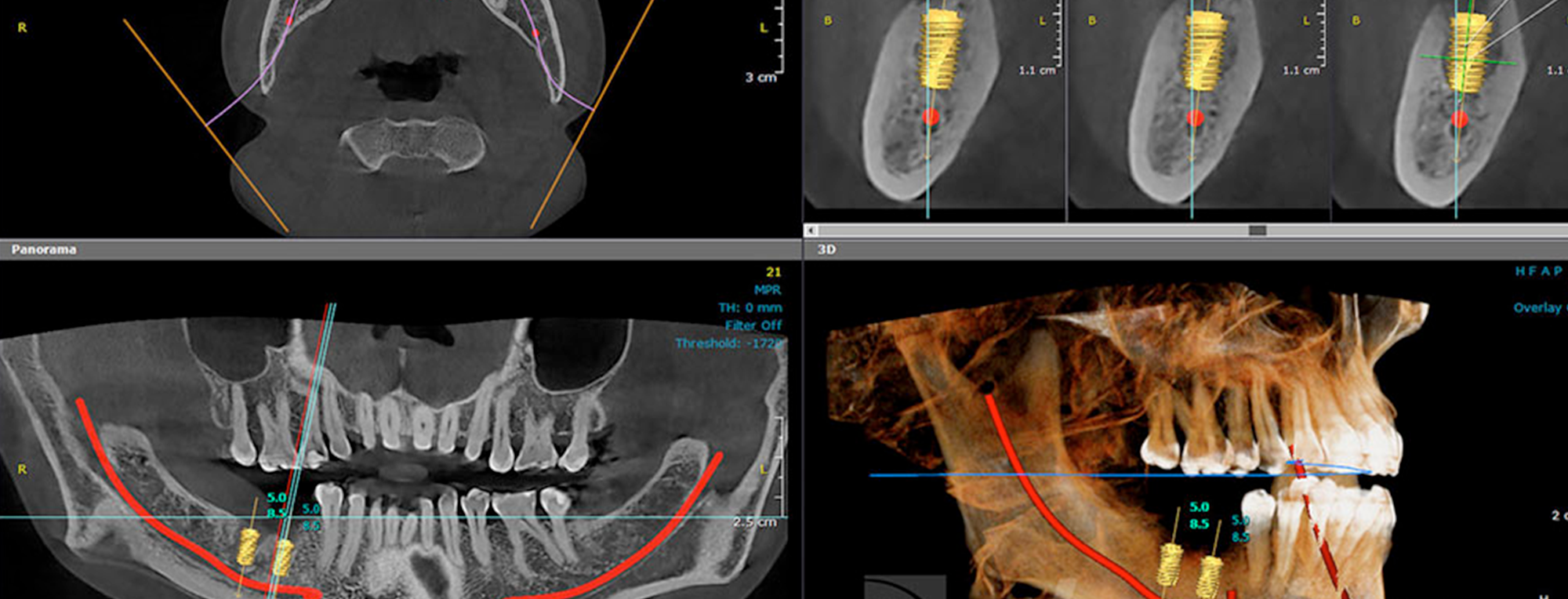 ¿Por qué una Radiografía Panorámica no es suficiente para un diagnóstico dental completo?
