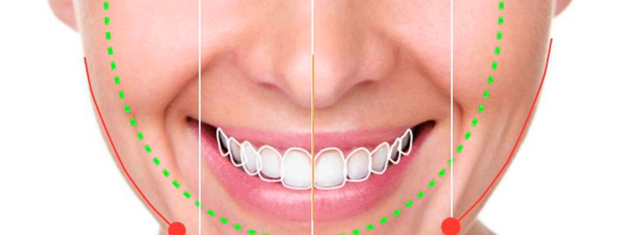 Tratamientos que intervienen en el diseño de sonrisa